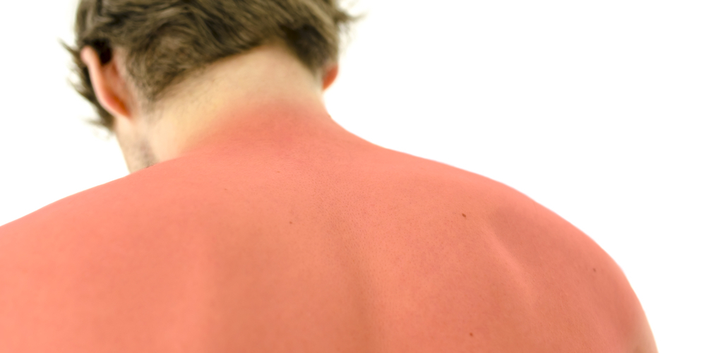 Sun burn on a man's back
